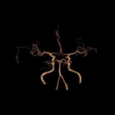 左侧大脑后动脉开窗畸形图片,脑部基底动脉开窗畸形如何治疗