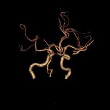 左侧大脑后动脉开窗畸形图片,脑部基底动脉开窗畸形如何治疗