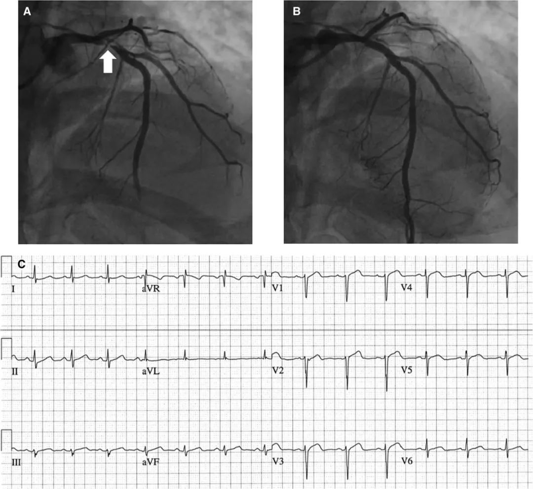 24小时动态心电图有stt改变,心电图st段改变与st-t改变区别
