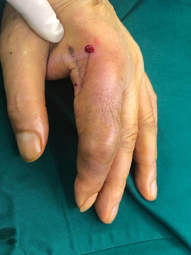 被鱼刺刺到没有明显的症状,被鱼刺扎了一下然后就没感觉了