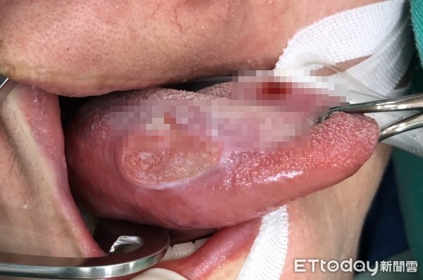 舌头发霉！她硬撑2个月竟烂出10元深窟　医叹：第二期了