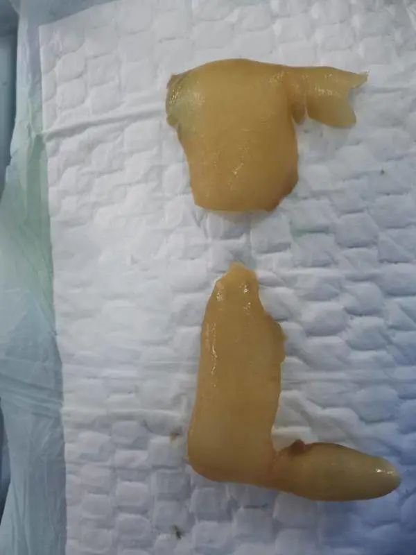 16岁男孩罕见皮肤病,17岁少年患两种罕见病