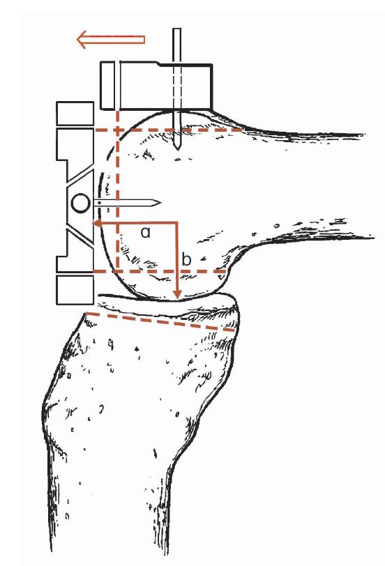 膝关节置换单膝和全膝,全膝关节置换能跪吗
