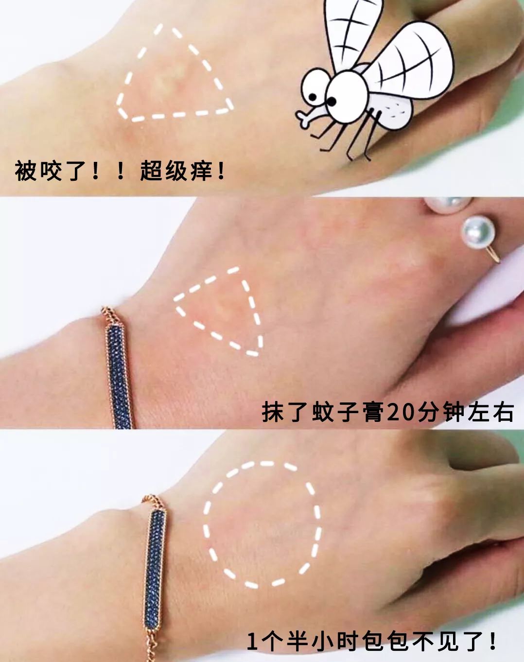 1罐搞定一整夏！20秒止痒消肿，让蚊虫再无嚣张机会