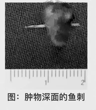 五旬阿姨舌头肿胀怀疑患癌，一查想不到“元凶”竟是……