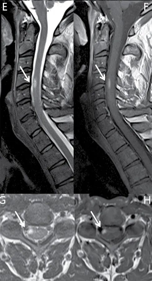 哪些东西能帮助多发性硬化恢复,多发性硬化治疗原则和方法