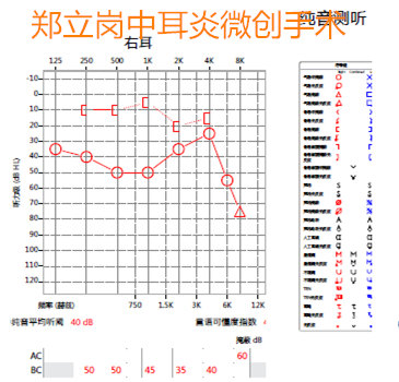 不明原因的听力下降是怎么回事,胆脂瘤中耳炎出血意味着什么呢