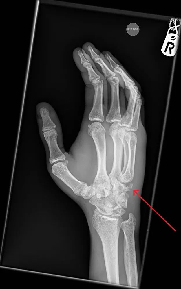 右手桡骨骨折恢复视频,手腕钩状骨骨折