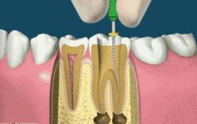 3分钟让你看懂什么是根管治疗丨胶东半岛口腔医院资深专家周安兴强调技术优势