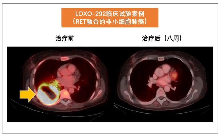 国内首款RET靶向药 (ret靶向药仿制版)