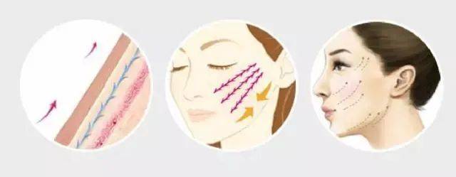 线雕抗衰老的方法,线雕改变了脸型丑死了咋办