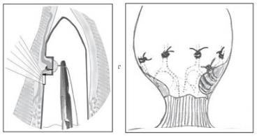 超声多普勒引导下痔疮手术多少钱,超声多普勒治疗痔疮优缺点