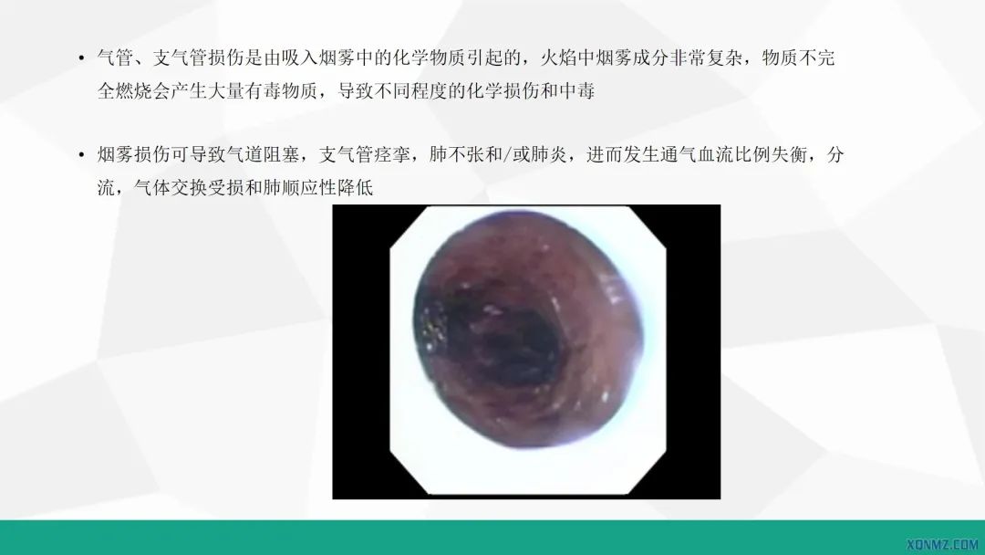 外科烧伤病人的护理教学视频,烧伤患者护理教学查房讲解视频