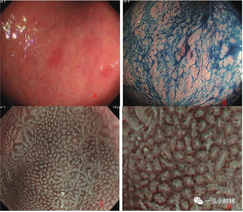 肠上皮化生做什么检查,肠化生内镜看得出来吗