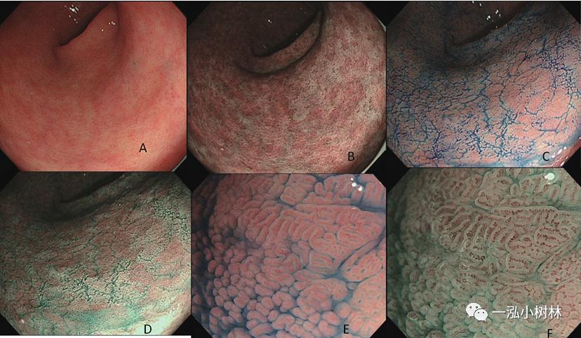 肠上皮化生做什么检查,肠化生内镜看得出来吗