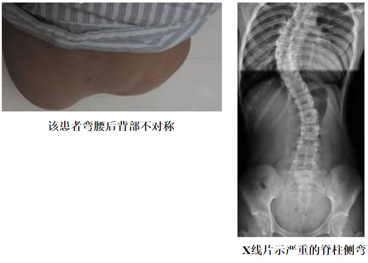 脊柱侧弯骨科治疗方法,筋骨堂正骨整脊理疗