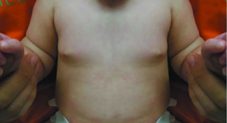 乳腺几岁开始发育算早熟,儿童乳腺发育分期标准是什么