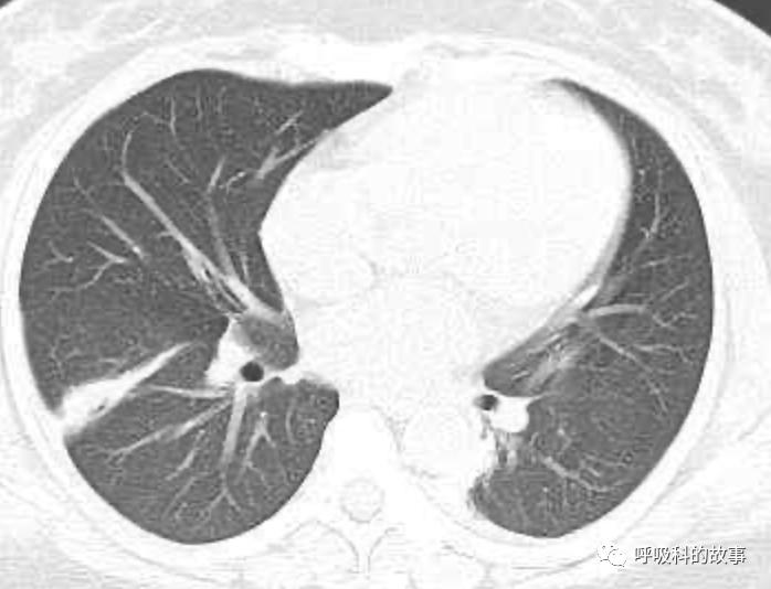 五花八门的发热之一—药物热（1）