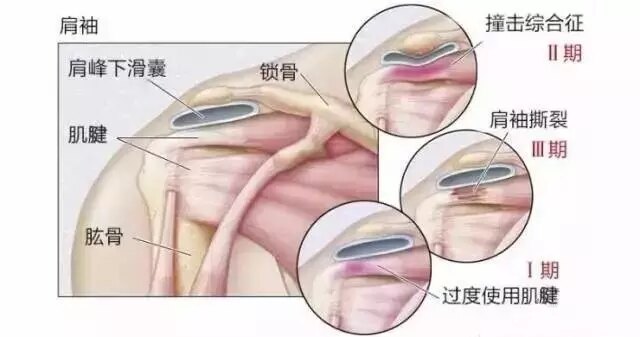 拯救肩颈,肩峰下撞击综合征最好的治疗方法