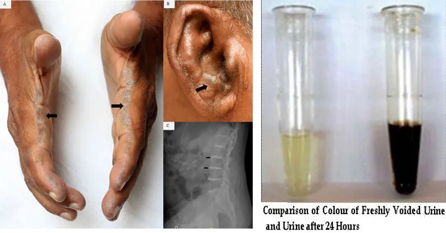 表现为技工手的尿黑酸尿症