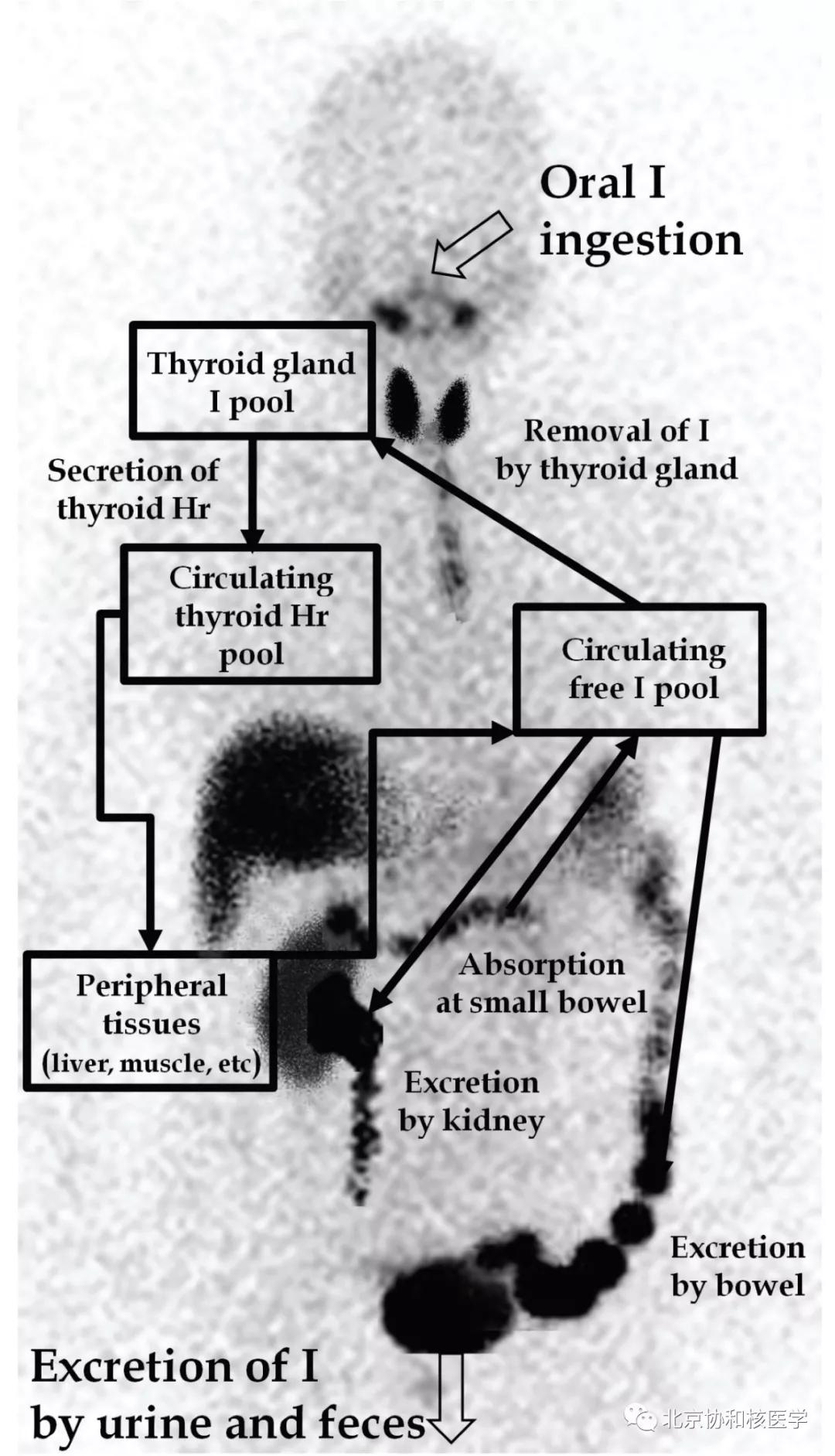 碘扫描最坏的结果,放射性核素扫描可以鉴别诊断吗