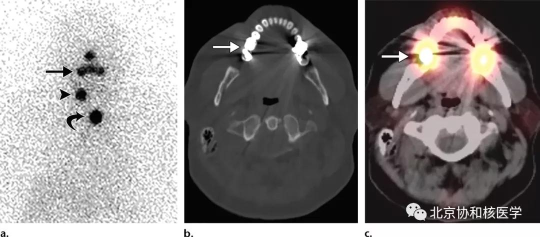 碘扫描最坏的结果,放射性核素扫描可以鉴别诊断吗