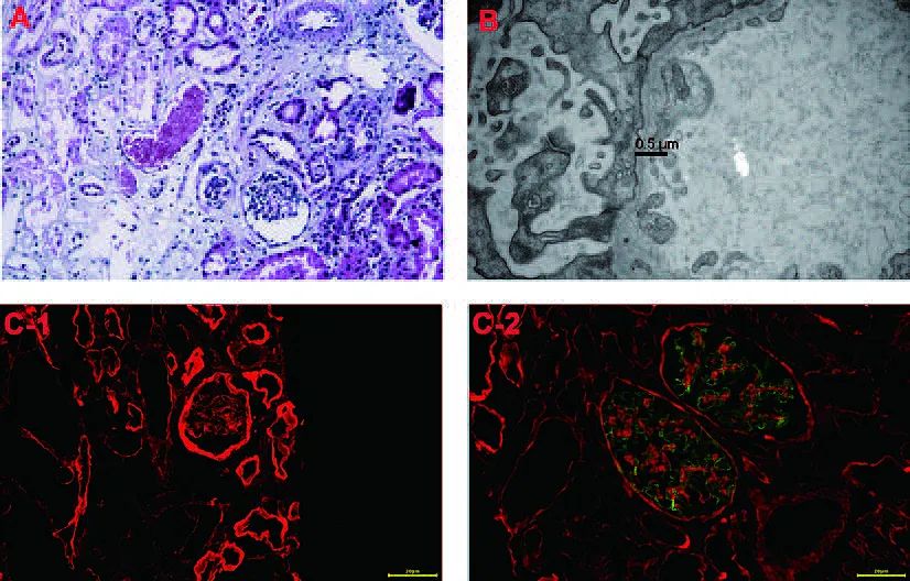 col4a5基因怎么检测,col4a5基因突变严重吗