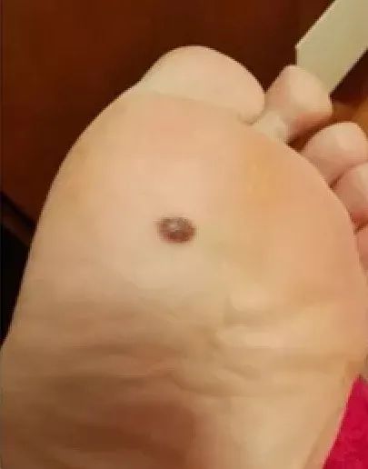 黑痣癌变的痣会很大吗,黑痣癌变一般是一个痣还是好多