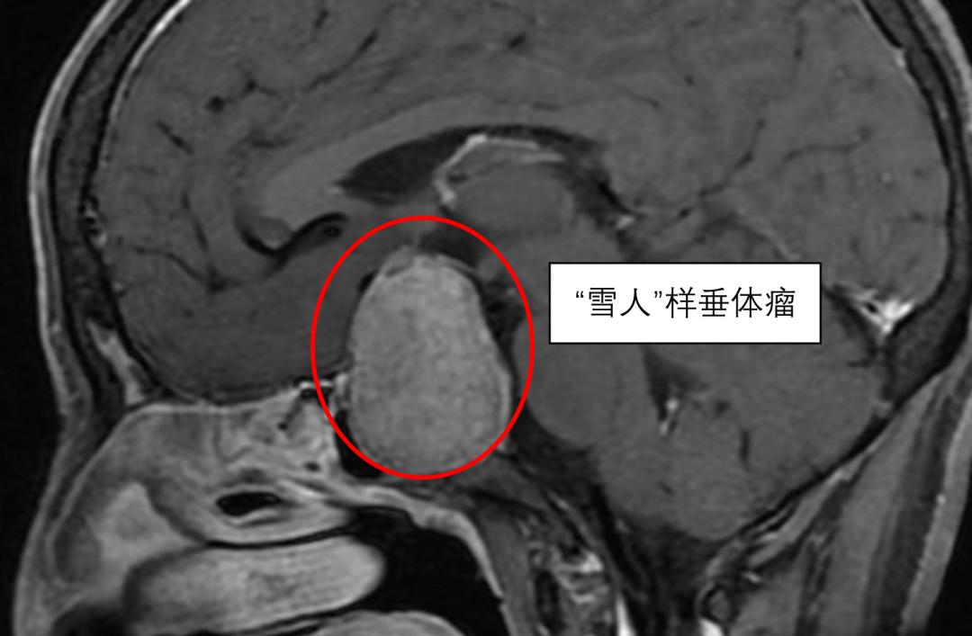 47岁女士以为当奶奶累得更年期提前，一查竟是脑子里长了个“雪人”