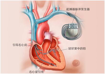 心肺复苏器救人,心脏除颤器救人