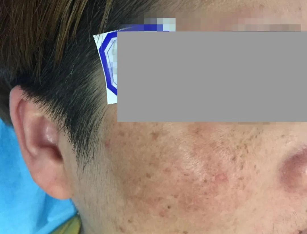 脸上长斑了怎么消除最有效中医,脸上长斑中医怎么治疗效果怎么样