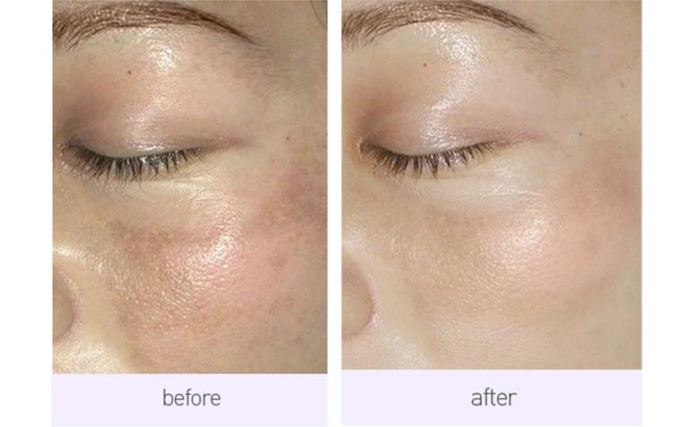 让脸上斑去掉,让脸上的皮肤变白