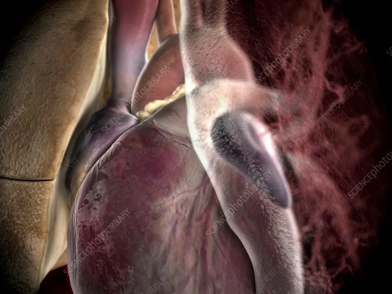 血清尿酸升高的意义,尿酸高导致心梗