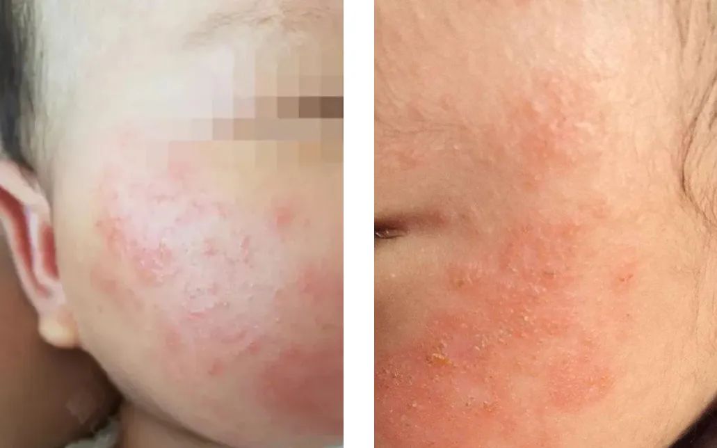 冬天宝宝脸干燥可以涂什么护肤品,儿童护肤冬季防皲裂