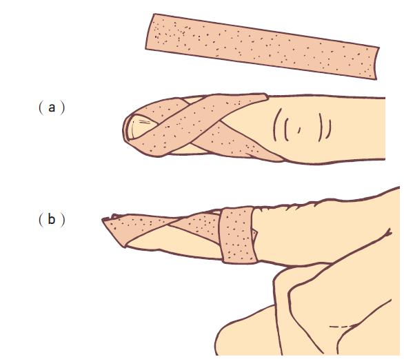 肩部运动损伤的检查4个方法,肩部各种损伤