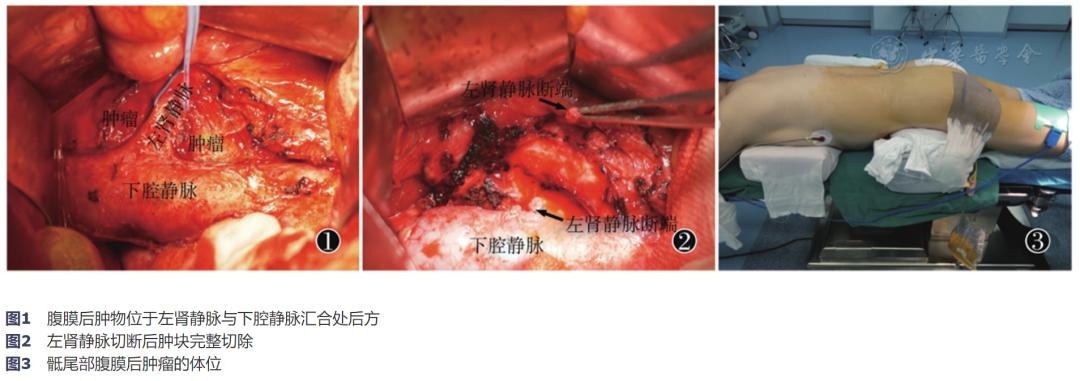 腹膜后肿瘤手术入路及相关技巧