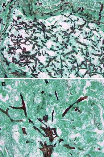 老人左乳房下胸痛,老人胸部结节痛