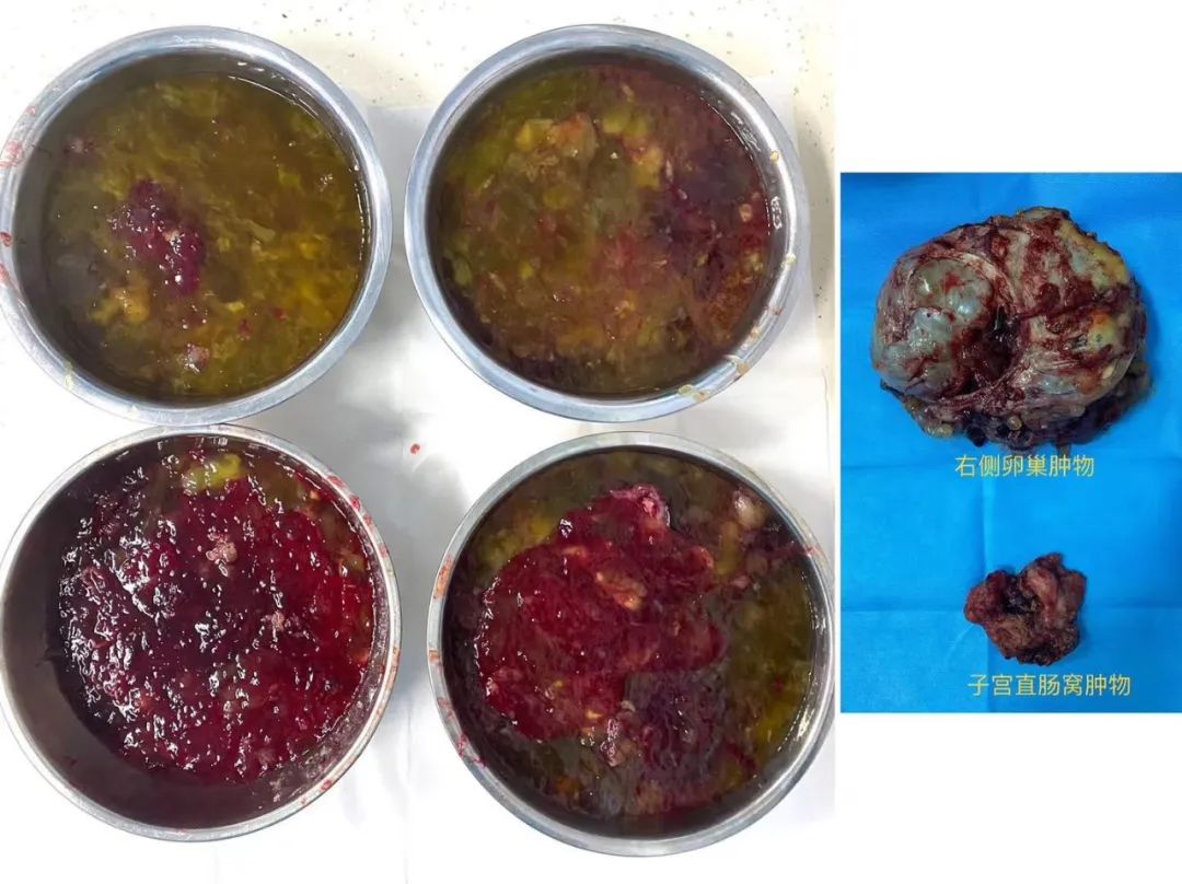 肠话短说|陈功教授病例分享：低级别粘液性肿瘤腹腔“15kg巨型肿物”减瘤术