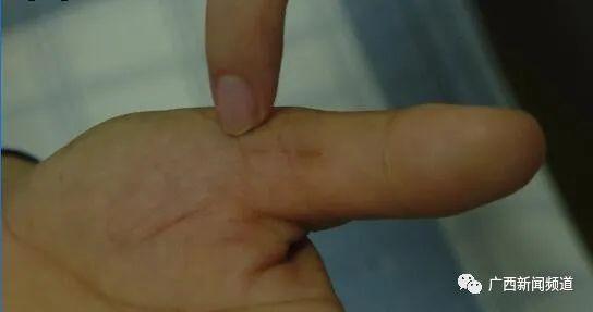 女子剁猪骨受伤患病,广西女子剁猪骨患上罕见的病