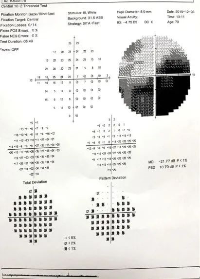 【受试者招募】经颅直流电刺激术治疗视神经萎缩患者视野缺损