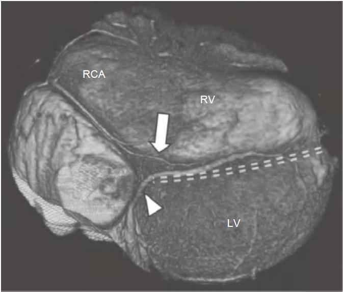 冠脉ct血管示意图的亮点是什么,冠脉血管造影识图