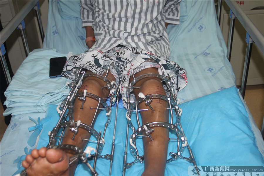 广西壮族自治区江滨医院康复科,广西江滨医院康复科收费