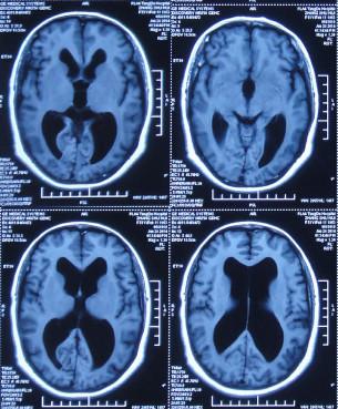 脑积水腹腔分流术后头晕头痛,脑积水分流术后发烧会有什么后果