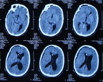 脑积水腹腔分流术后头晕头痛,脑积水分流术后发烧会有什么后果