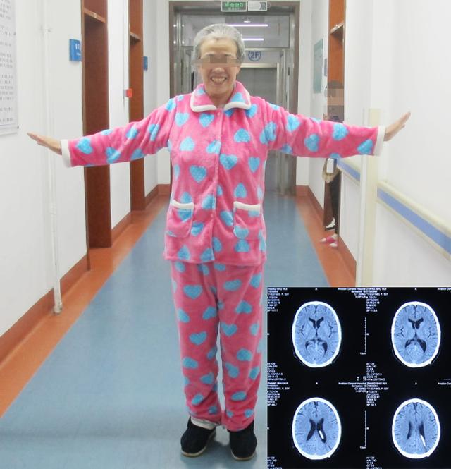 脑积水腹腔分流术后头晕头痛,脑积水分流术后发烧会有什么后果