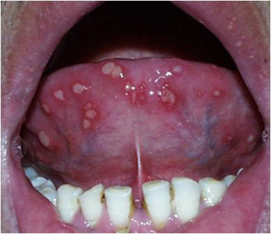 口腔溃疡超过两周一定是癌吗,口腔溃疡超过一个月不愈合应就诊