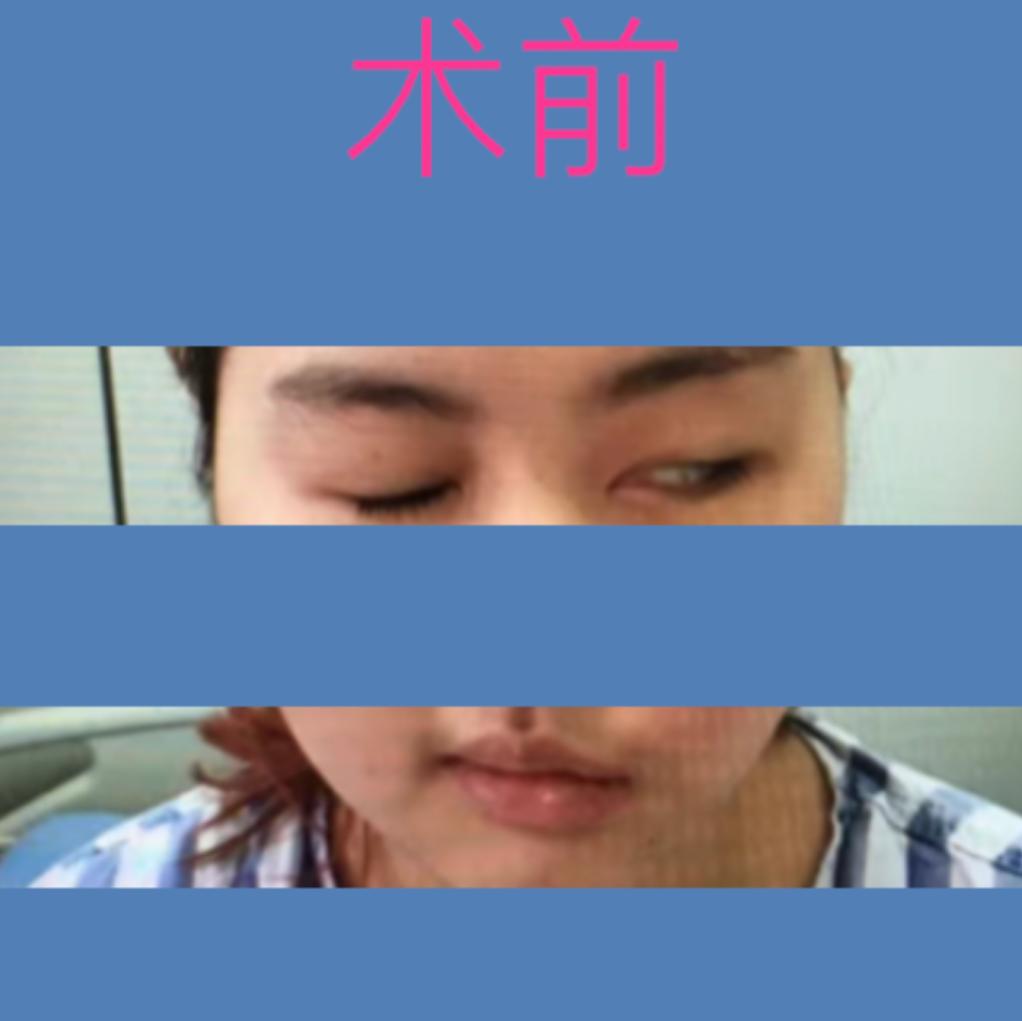 四川华西医院治疗面瘫怎么样,面瘫其实很难治愈