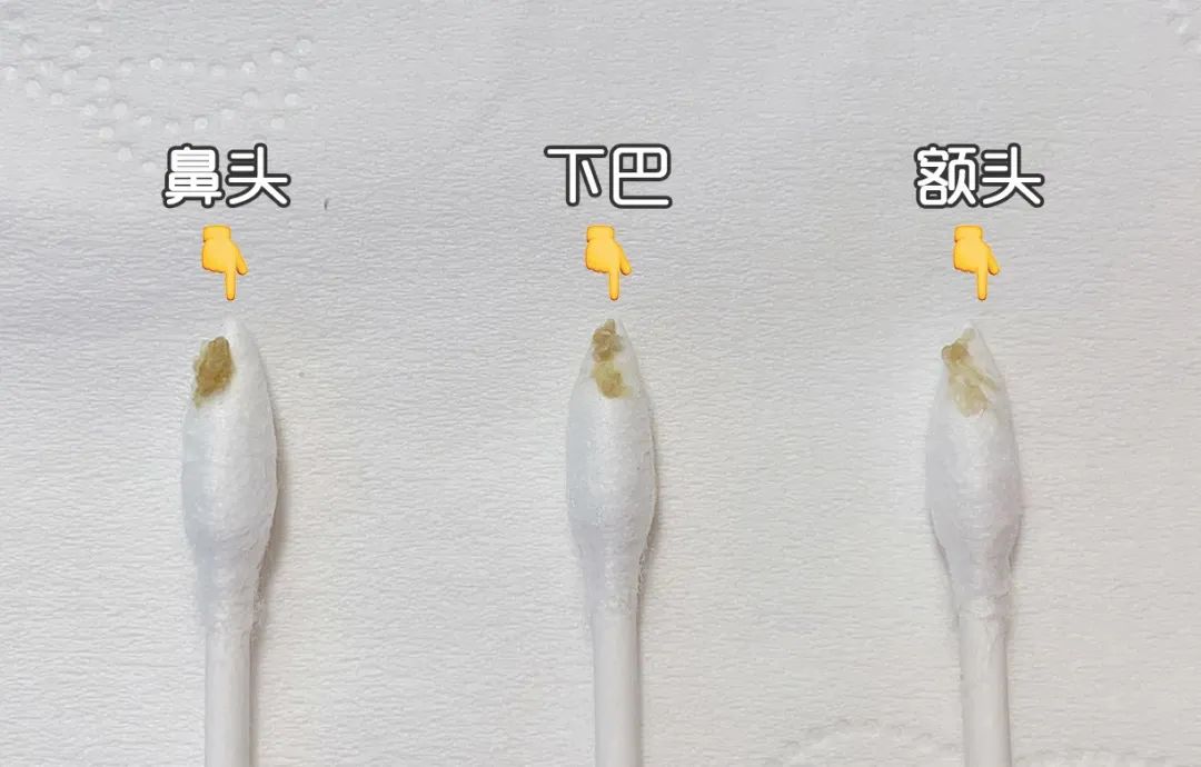 痘痘挤出的白米粒是什么,痘痘挤出来的白色乳浆是什么