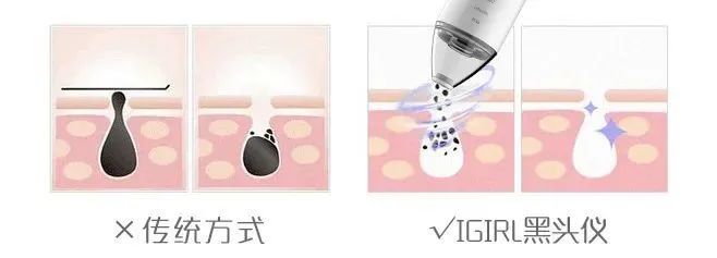 痘痘挤出黄水还是血水,痘痘挤出来的白色乳浆是什么