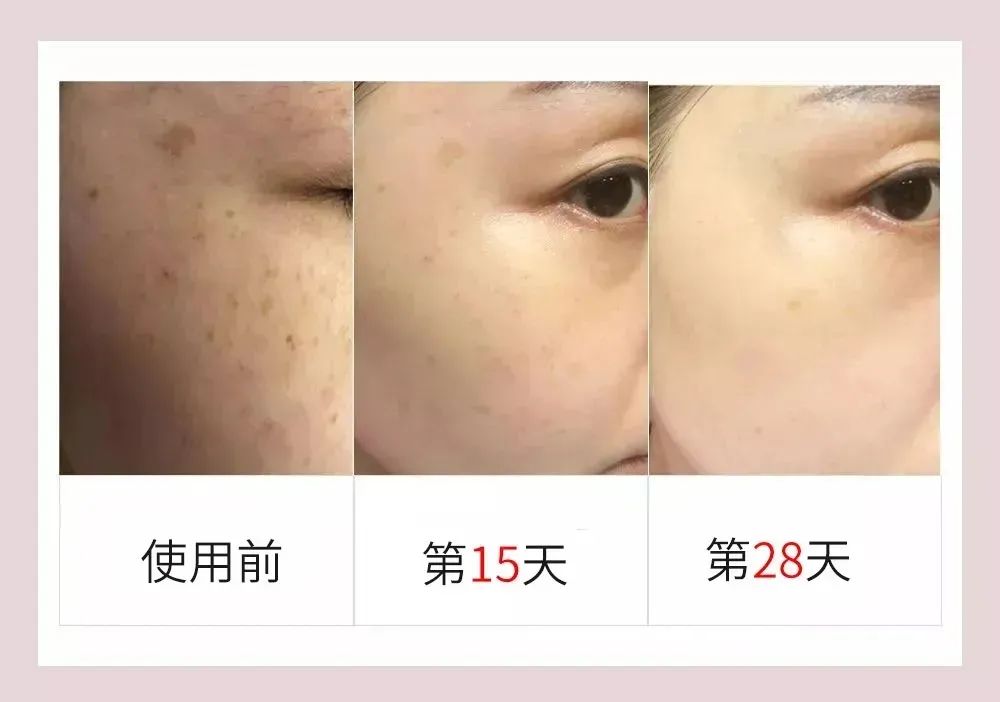 花了3万做激光,才彻底懂了:医生为什么劝你别去斑